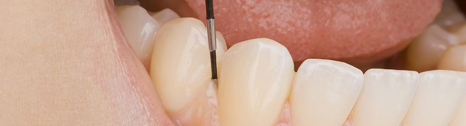 「歯ぐきが腫れている・出血する」は進行した歯周病のサインです