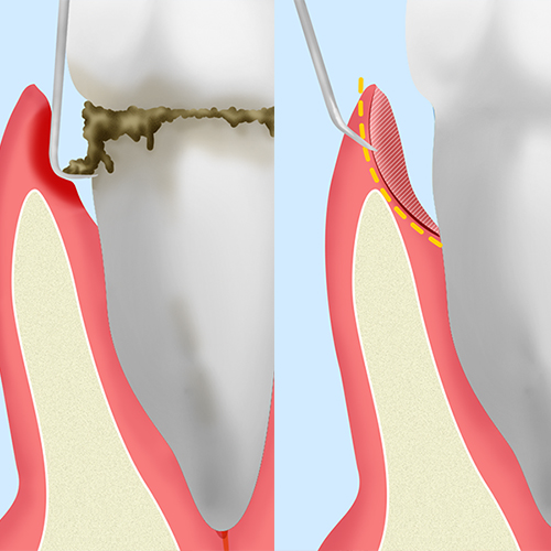 歯周ポケットそうは術